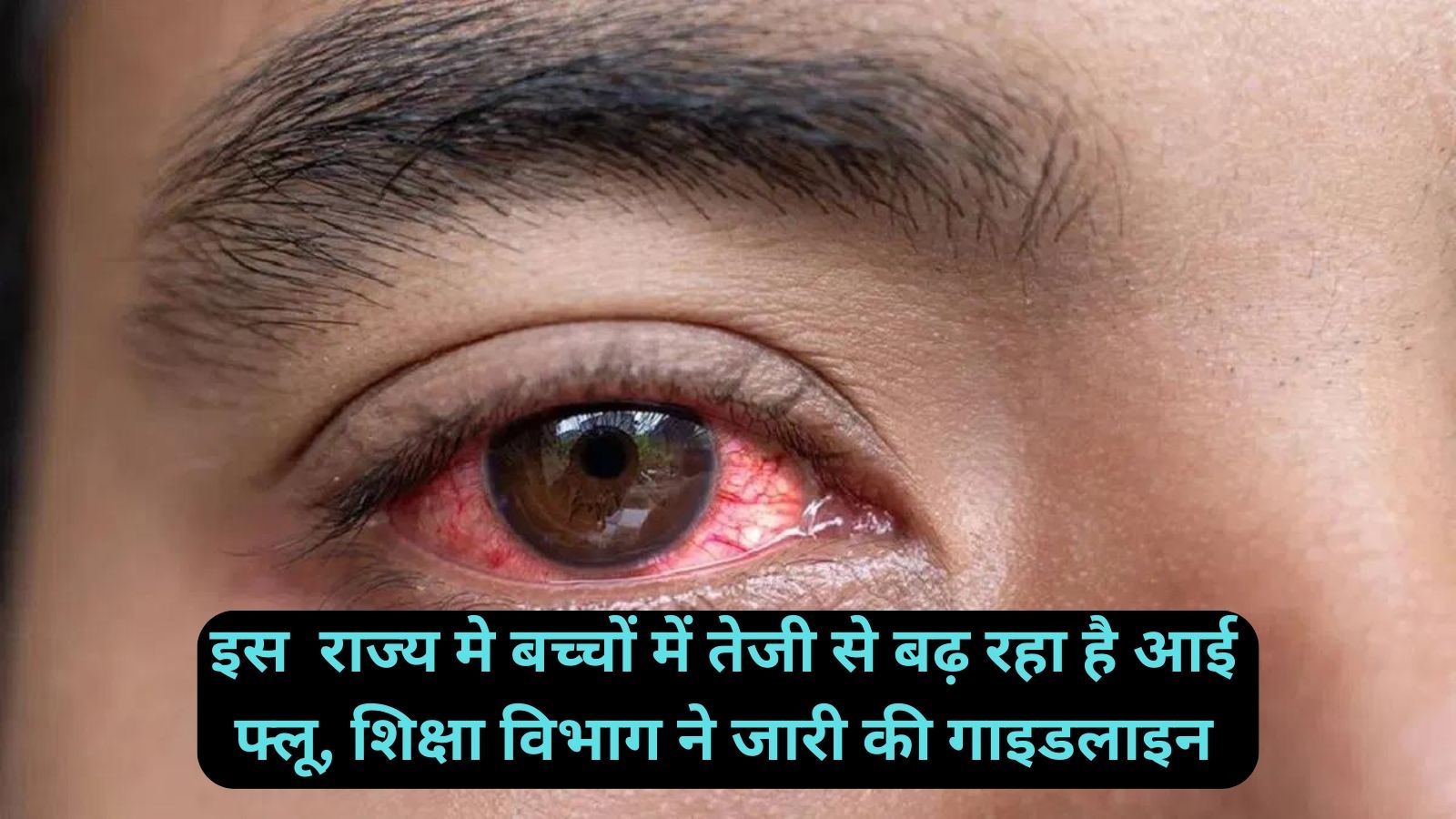 Eye Flu:इस राज्य मे बच्चों में तेजी से बढ़ रहा है आई फ्लू, शिक्षा विभाग ने जारी की गाइडलाइन